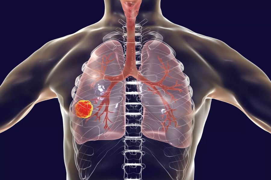 Symptômes de l'inflammation do côlon gauche - Anadolu Medical ...